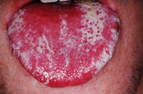 oral thrush mouth candidiasis infection fungal throat symptoms sores red candida patches candidosis causes oropharyngeal roof mucosa sore gum buccal